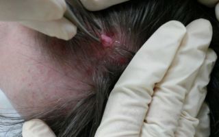 Бородавки на голове и в волосах — причины появления и методики удаления
