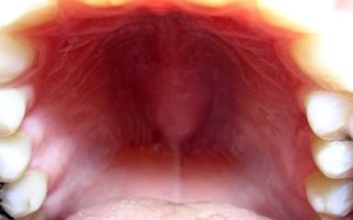 Папилломы мягкого неба во рту: причины образования и лечение
