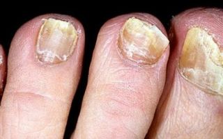 Лечение грибка ногтей луком