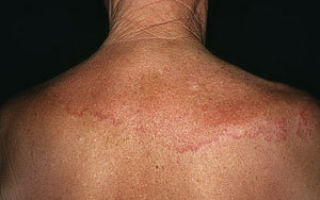 Грибковые заболевания кожи (микоз) — симптомы и лечение