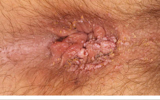 Папилломавирусная инфекция у женщин: симптомы, диагностика, лечение