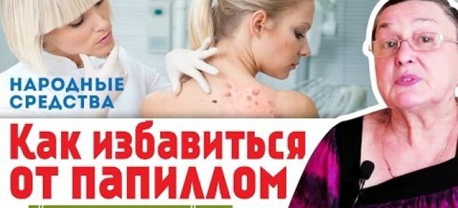 Лечение папиллом чесноком: поможет ли?