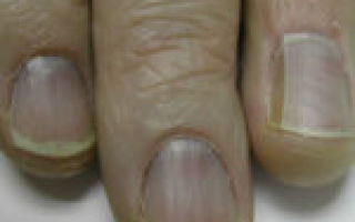 Как лечить кандидоз ногтей?