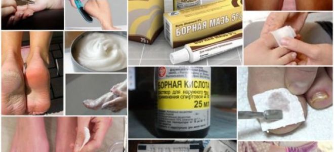 Лечение грибка борной кислотой