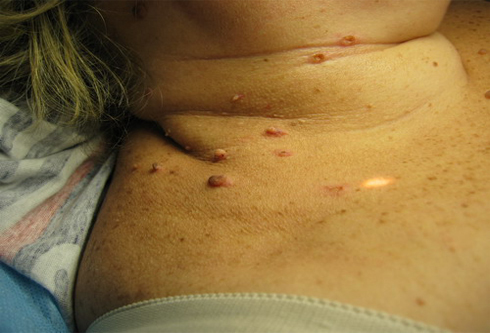 Лечение папиломо вирусной инфекции на шее: методы