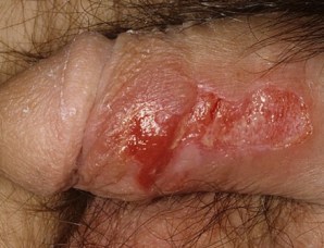 Половая инфекция герпес: как выявить и лечить