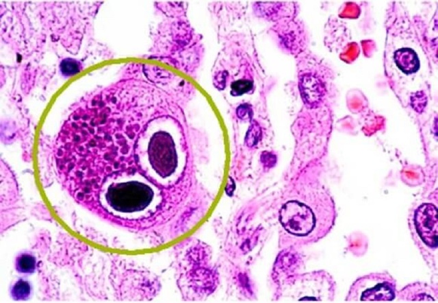 Цитомегаловирус в мазке: что это значит и зачем его определяют