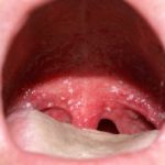 Сыпь при мононуклеозе: характеристика, ампициллиновая сыпь
