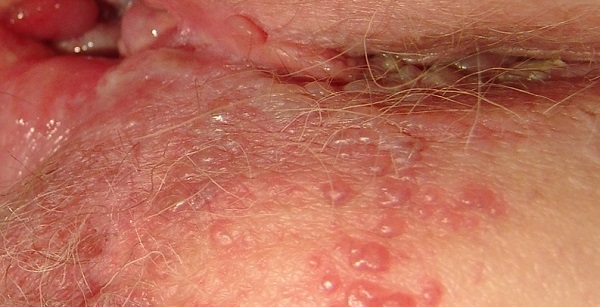 Половая инфекция герпес: как выявить и лечить