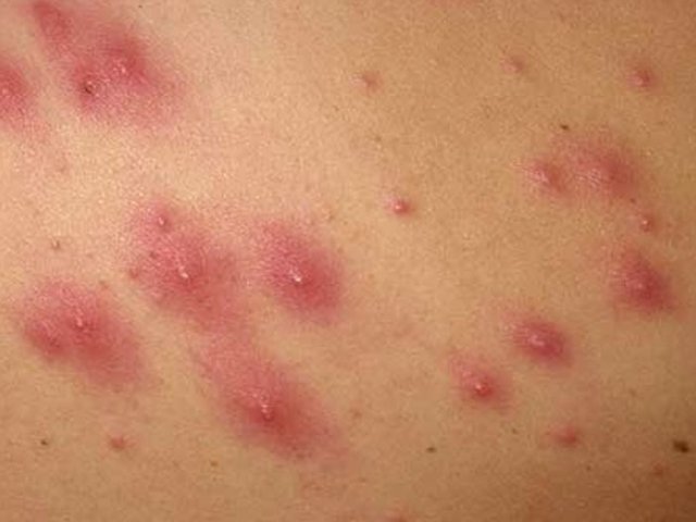 Стафилококк на коже: формы заболеваний и их лечение