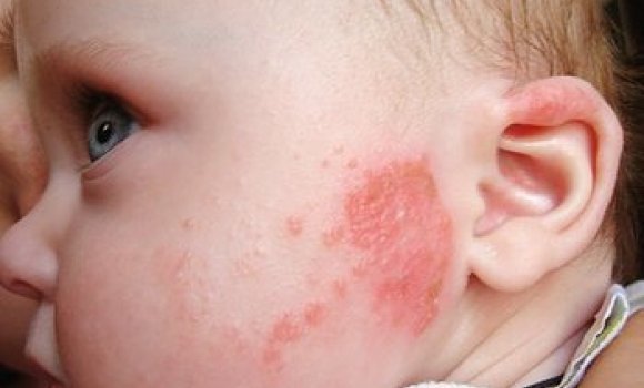 Стрептококковая инфекция на коже: причины, диагностика и лечение