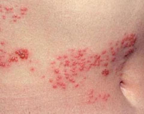 Герпесная инфекция: вирусное заболевание с различными симптомами