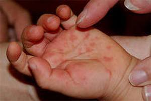 cыпь при энтеровирусной инфекции: у детей, взрослых, характеристика