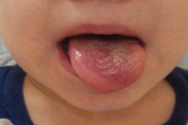 Мононуклеоз: симптомы и лечение у детей, причины возникновения