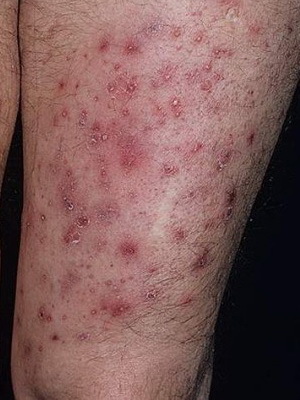 Заболевания кожи инфекционные: возбудители, клиника, лечение