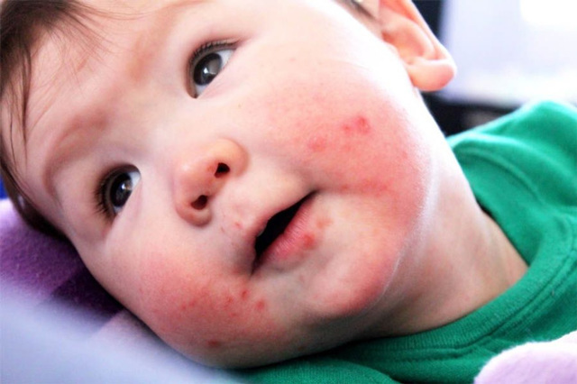Энтеровирусная инфекция: лечение у детей, правила и особенности