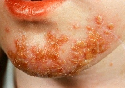 Стрептококковая инфекция на коже: причины, диагностика и лечение