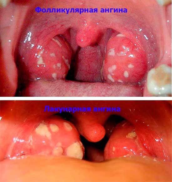 Золотистый стафилококк в горле: что делать, как выявить и лечить