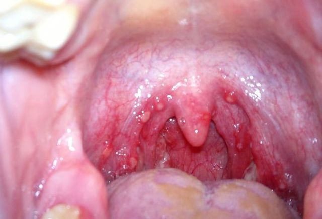 Стафилококк в горле: норма или патология, что делать