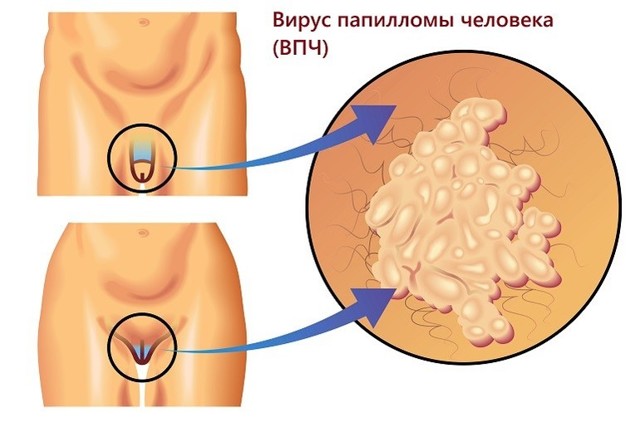 Папилломавирусная инфекция у мужчин: симптомы, опасности при заражении