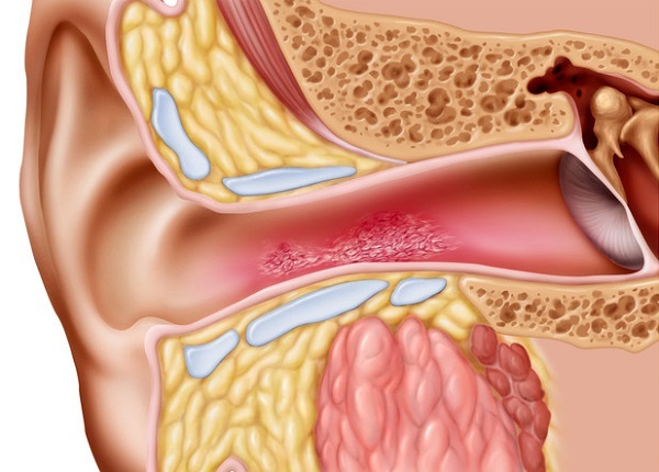Стафилококк в ухе: проявления, осложнения, лечение