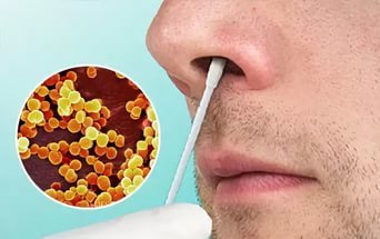 Золотистый стафилококк в носу: причины, симптомы, заболевания