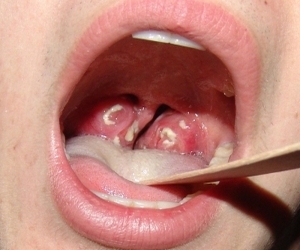 Золотистый стафилококк в горле: что делать, как выявить и лечить