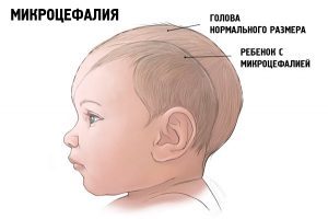 Цитомегаловирус у новорожденных: симптомы, диагностика, лечение