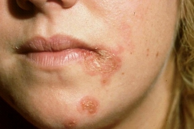 Заболевания кожи инфекционные: возбудители, клиника, лечение