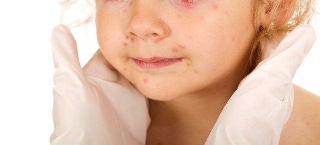 Инфекционный мононуклеоз у детей: пути передачи, симптомы, лечение
