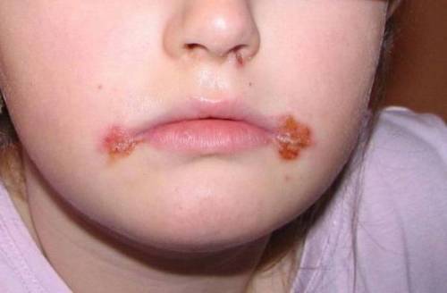 Герпетическая инфекция у детей: симптомы и лечение