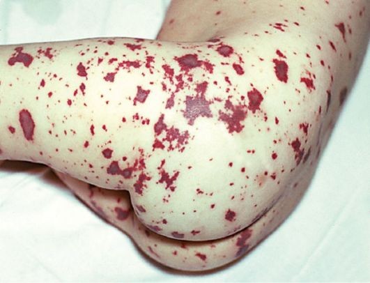 Гонококковая инфекция: симптомы, диагностика и лечение