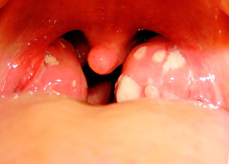 Стафилококк в горле: лечение, пути заражения, профилактика