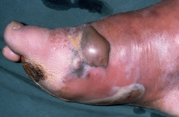 Анаэробная инфекция неклостридиальная: причины, симптомы, лечение