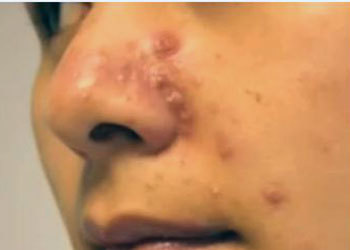 Золотистый стафилококк в носу: причины, симптомы, заболевания