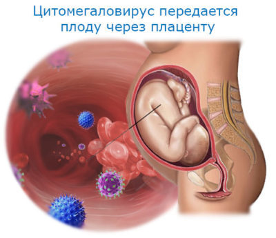 Герпес цитомегаловирус: описание инфекции, симптомы, лечение