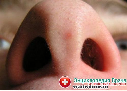 Стафилококк в носу: причины появления, симптомы, лечение