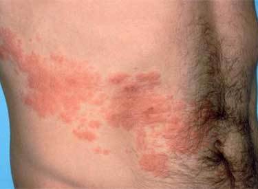 Герпесная инфекция: вирусное заболевание с различными симптомами