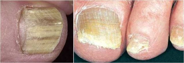 Чем опасен грибок ногтей на ногах если его не лечить?