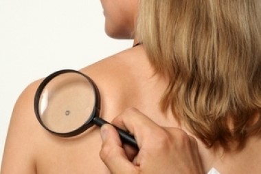 Бородавки на спине - причины и лечение - как выглядят