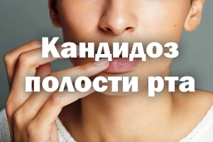 Эффективные средства при кандидозе полости рта