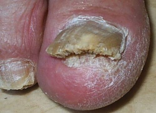 Препарат от грибка ногтей итраконазол - отзывы, инструкция, цена