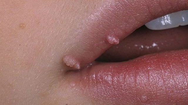 Бородавки во рту - на языке, губах и деснах - как избавиться