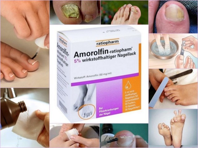 Аморолфин от грибка ногтей - отзывы, цена, аналоги