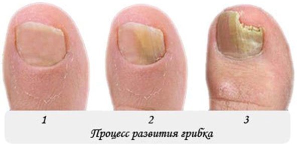 Грибок ногтя на большом пальце ноги и его лечение - 5 способов!
