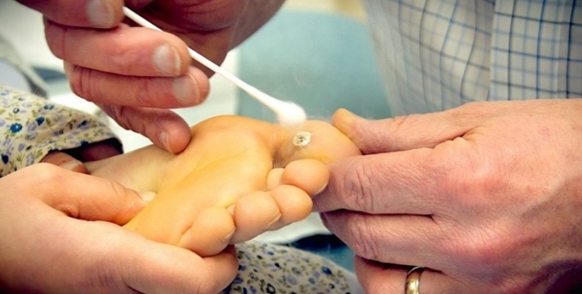 Как лечить шипицу на пальце ноги?