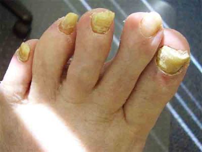 Утолщение ногтей на ногах - причины и лечение