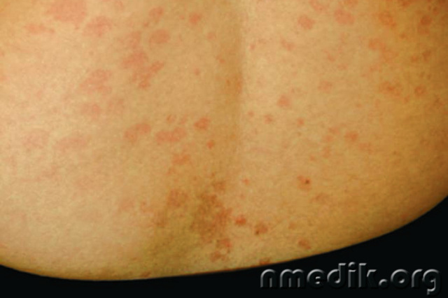 Грибковые заболевания кожи (микоз) - симптомы и лечение