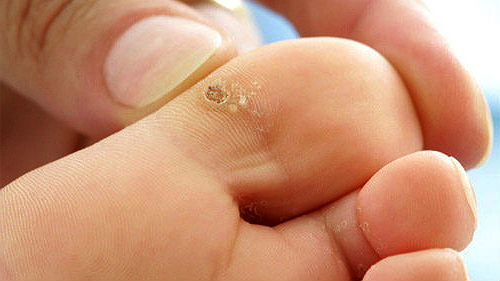 Как лечить шипицу на пальце ноги?