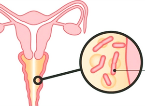 Генитальный кандидоз - молочница половых органов